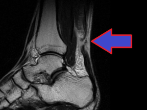 Mri Foot And Ankle Mri X Ray Ct Mri