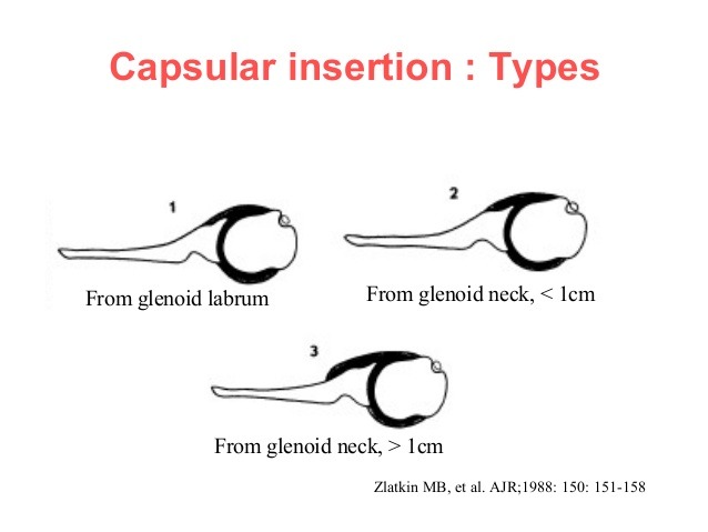 전방 견관절 탈구 (Anterior Shoulder Dislocation (Labrocapsular)) MRI - x-ray ...