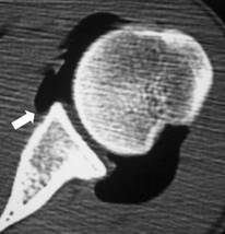 전방 견관절 탈구 (Anterior Shoulder Dislocation (Labrocapsular)) MRI - x-ray ...