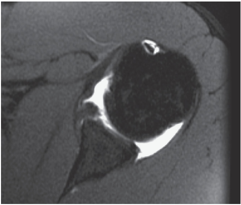 전방 견관절 탈구 (Anterior Shoulder Dislocation (Labrocapsular)) MRI - x-ray ...