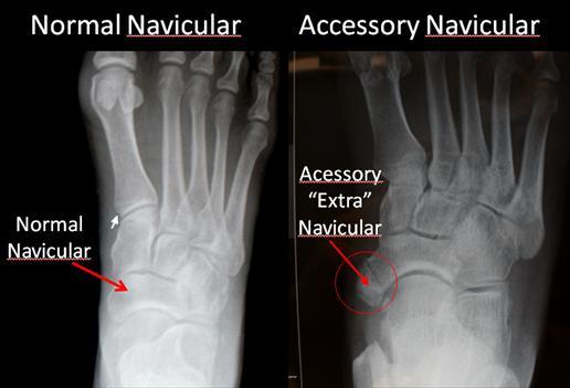 Accessory Bone Ankle And Foot