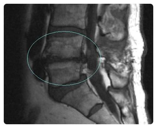 비외상성 척추 단순 방사선 촬영과 퇴행성 질환 - x-ray,ct, mri 진단 - 치료적 맞춤운동, 비타미네, 영성 연구소