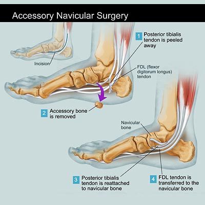 족부의 부골 Accessory bone 부주상골 주상골 부골 ankle and foot 치료적 맞춤운동 비타미네 영성 연구소