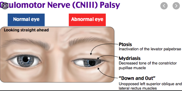 cranial nerve 3 palsy