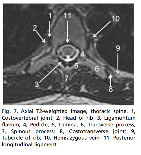 정상 척추사진 MRI - 정리해야.. - x-ray,ct, mri 진단 - 치료적 맞춤운동, 비타미네, 영성 연구소