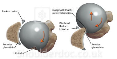 전방 견관절 탈구 (Anterior Shoulder Dislocation (Labrocapsular)) MRI - x-ray ...