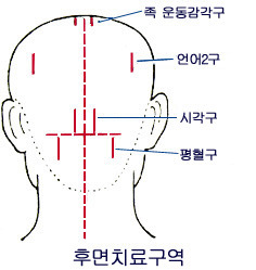 광명침 사혈법 종류 - 따주기/ 사혈요법 - 대한의 자랑스런 대체의학 광명건강 광명의학 KMHEALTH
