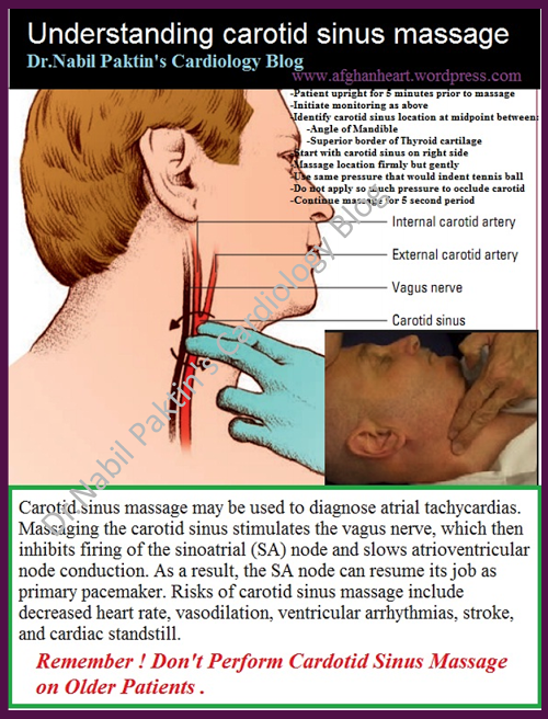 What Is A Carotid Sinus Massage Used For