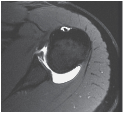 전방 견관절 탈구 (Anterior Shoulder Dislocation (Labrocapsular)) MRI - x-ray ...