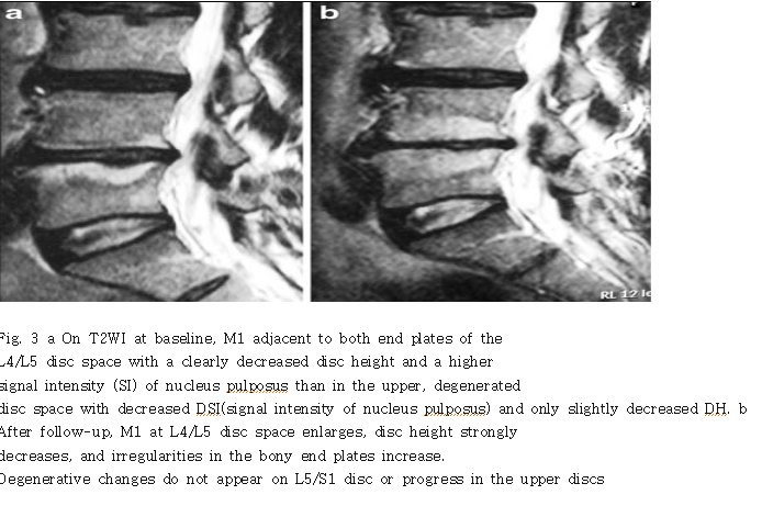 Re:modic change(vertebral endplate signal change) - Healing을 위해 - 치료적 ...