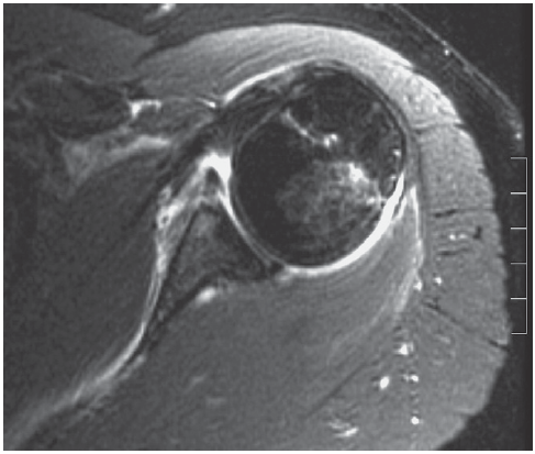 전방 견관절 탈구 (Anterior Shoulder Dislocation (Labrocapsular)) MRI - x-ray ...