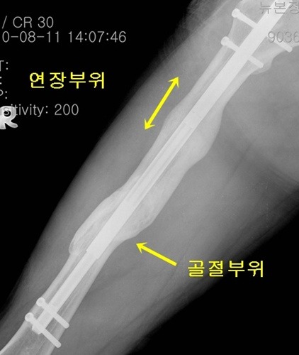 허벅지 ISKD(4cm 연장) 수술 후 내고정 제거 축하드립니다 ^^ - 다리길이차이(하지부동)-다양한 하지변형 교정 - 키크는 ...