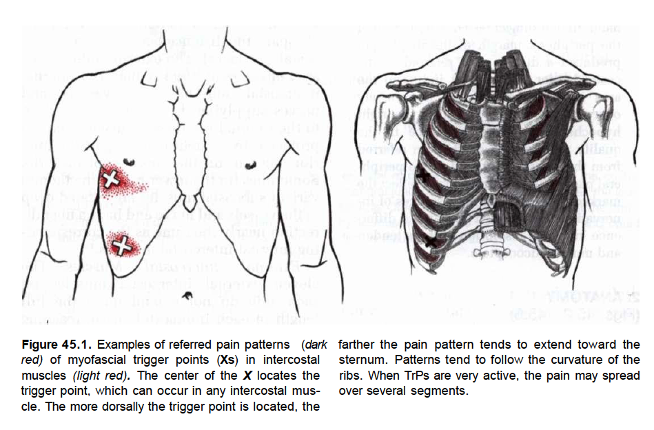 Межреберная невралгия справа. Триггер зубчатой мышцы. Триггеры передней зубчатой мышцы. Триггеры верхней зубчатой мышцы.