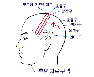 광명침 사혈법 종류 - 따주기/ 사혈요법 - 대한의 자랑스런 대체의학 광명건강 광명의학 KMHEALTH